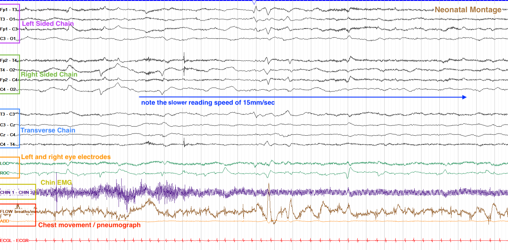 Neonatal EEG example