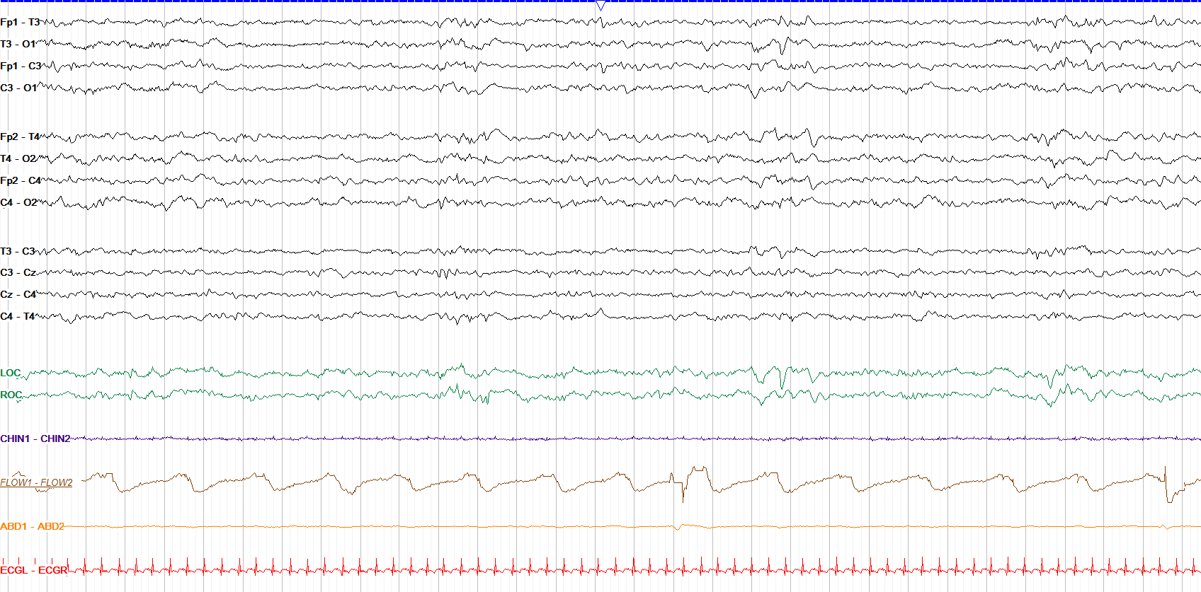 Tracé alternans