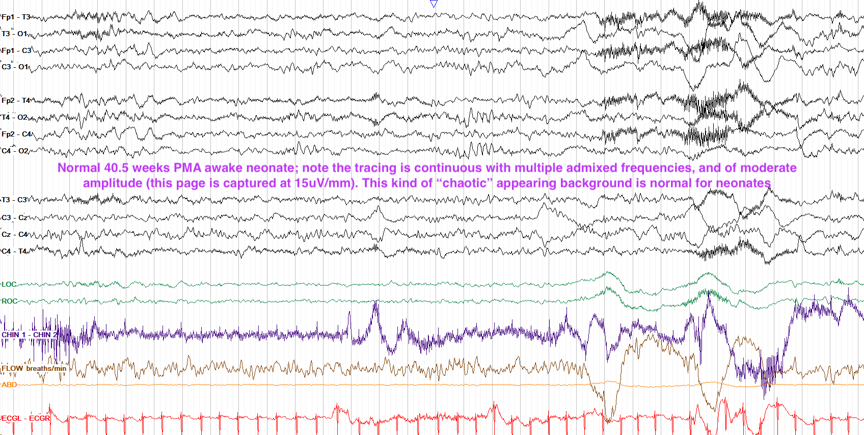 Normal full term awake neonate