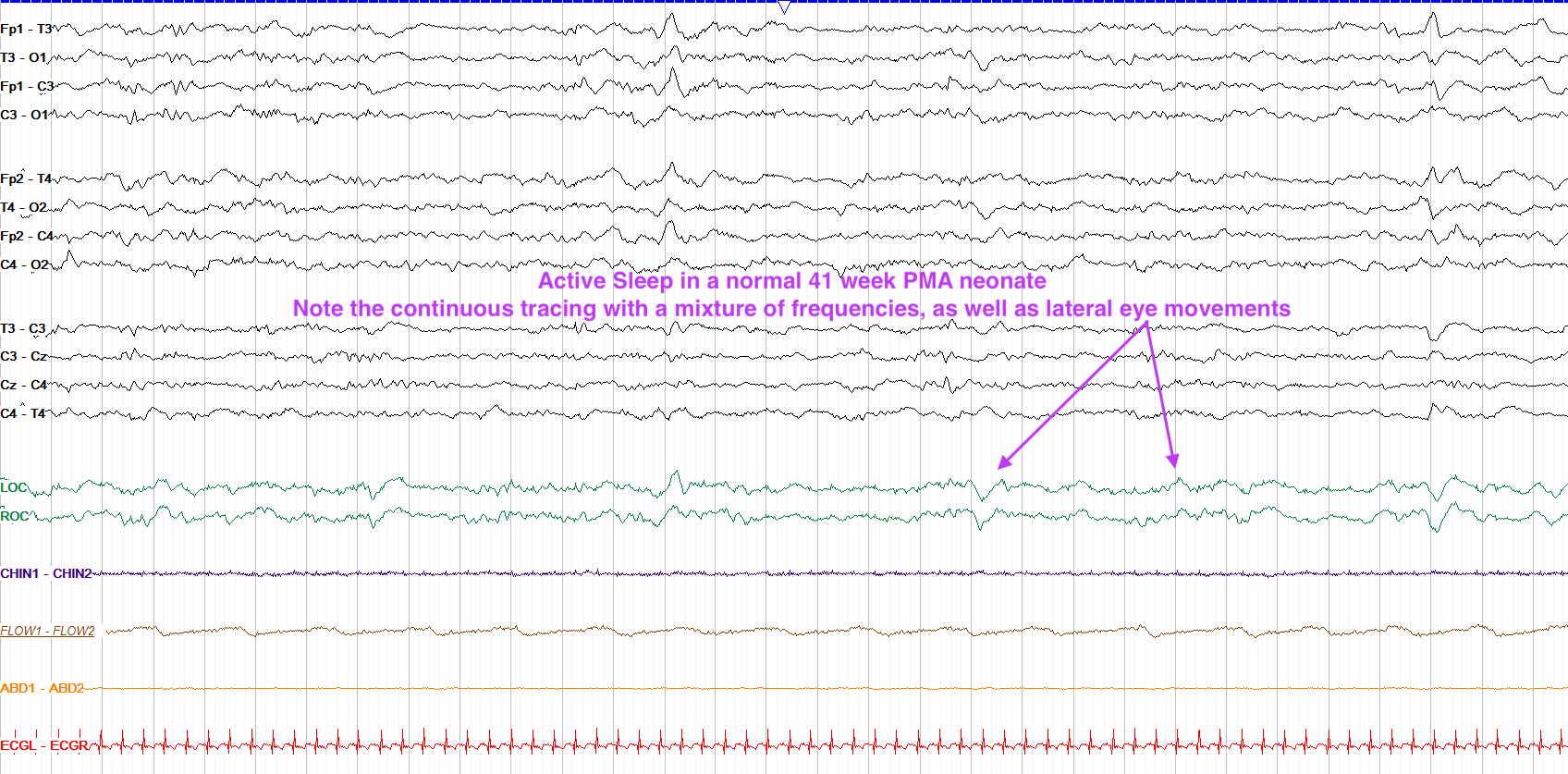Active sleep in neonate