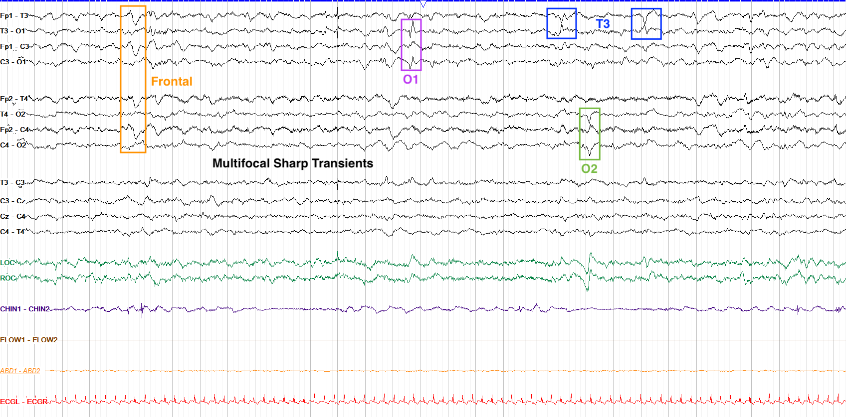Multiple multifocal sharp transients