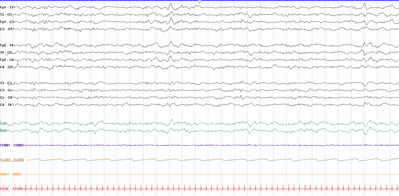 Active sleep at 41 weeks PMA