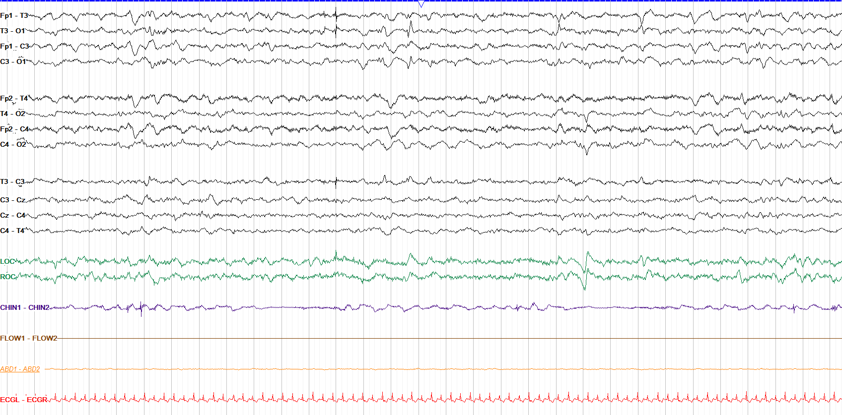 Multifocal sharp transients