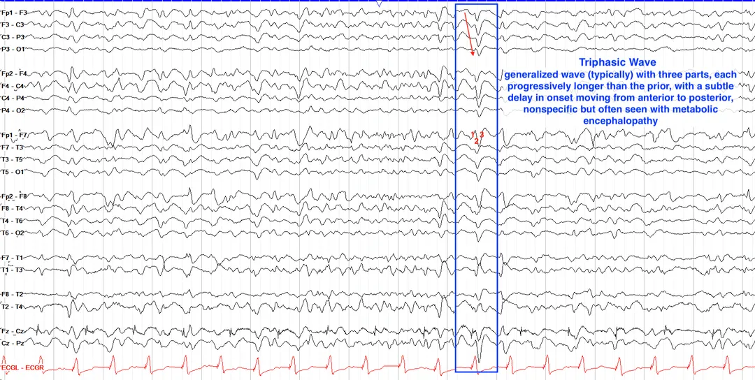 Triphasic waves example