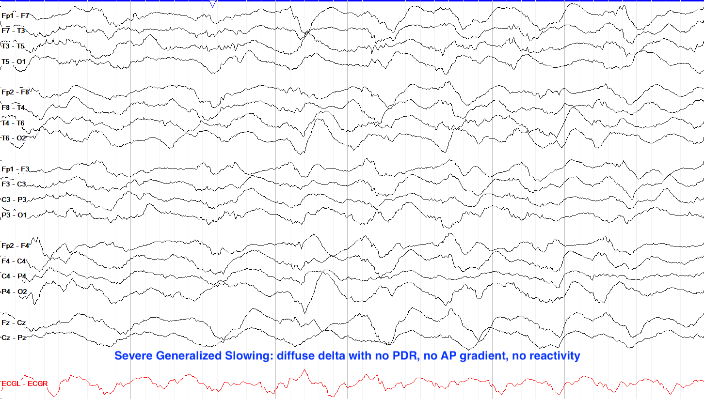 Severe Generalized Slowing