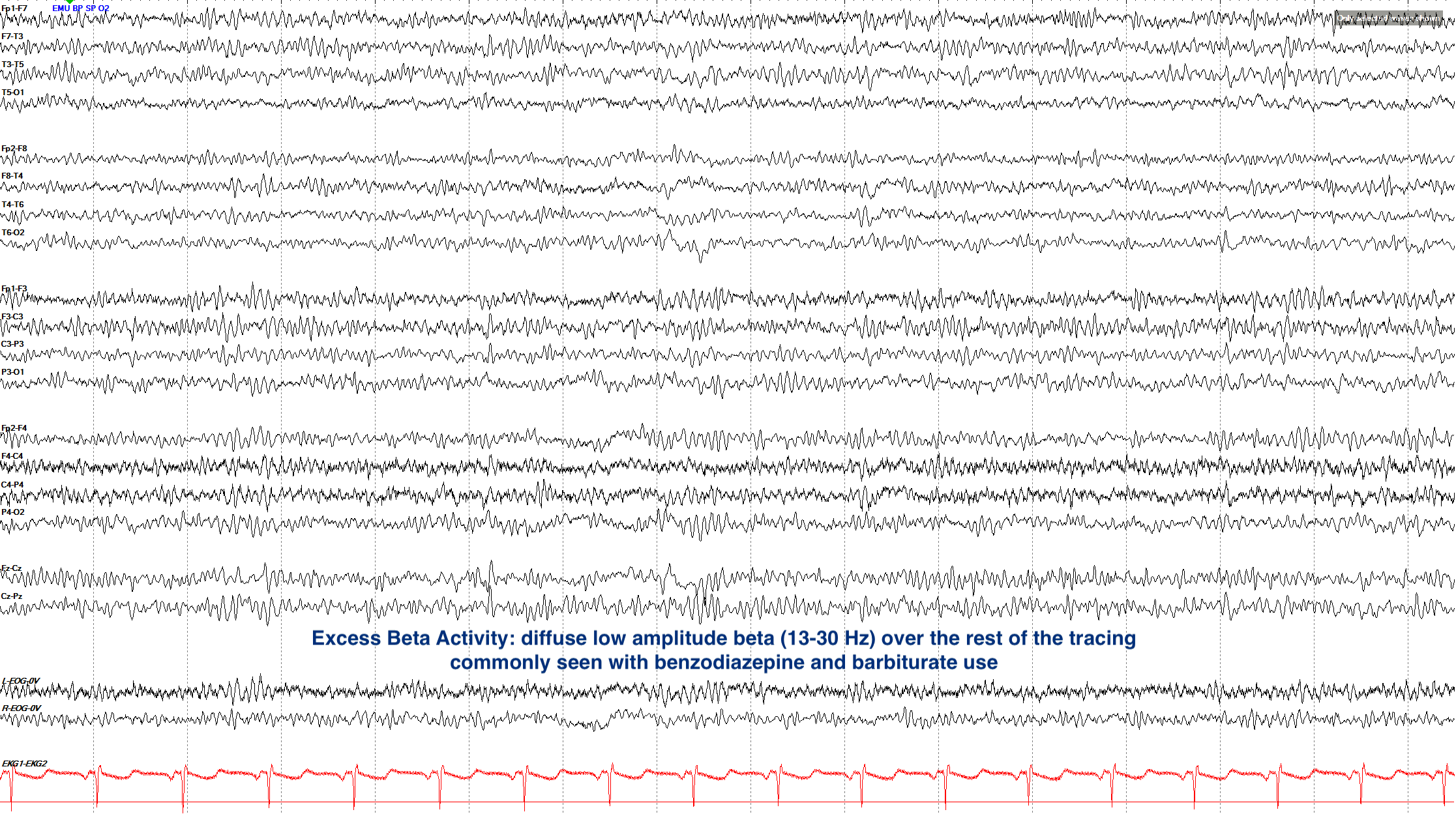Excess beta activity example