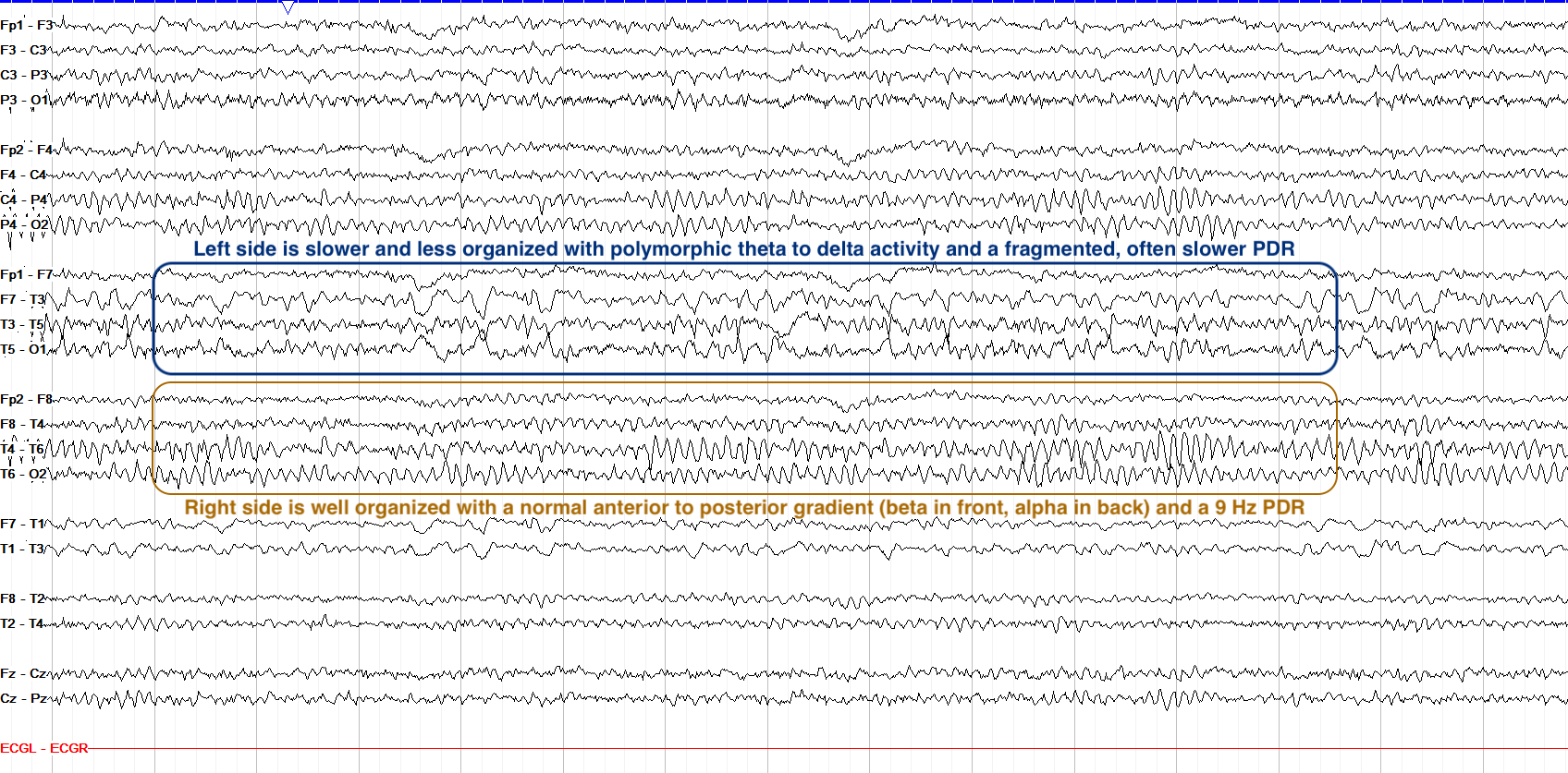 Continuous left hemispheric polymorphic delta slowing, maximal temporally