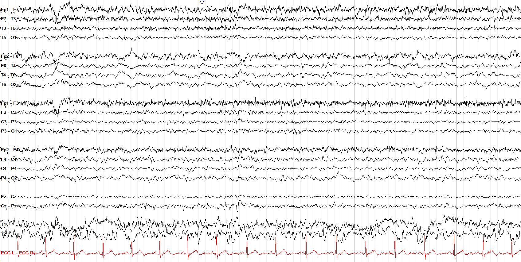 Right posterior polymorphic delta slowing