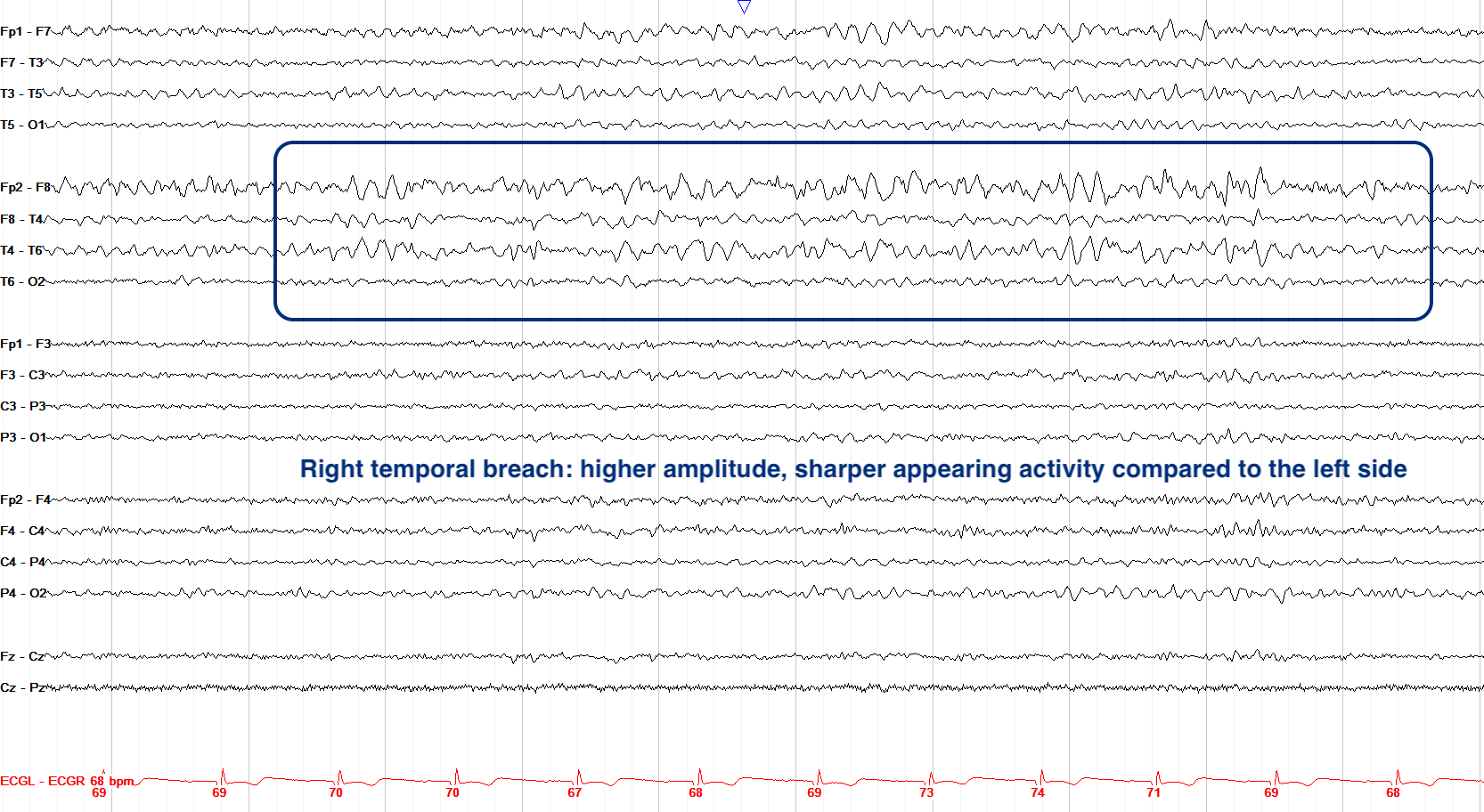 Right temporal breach activity example