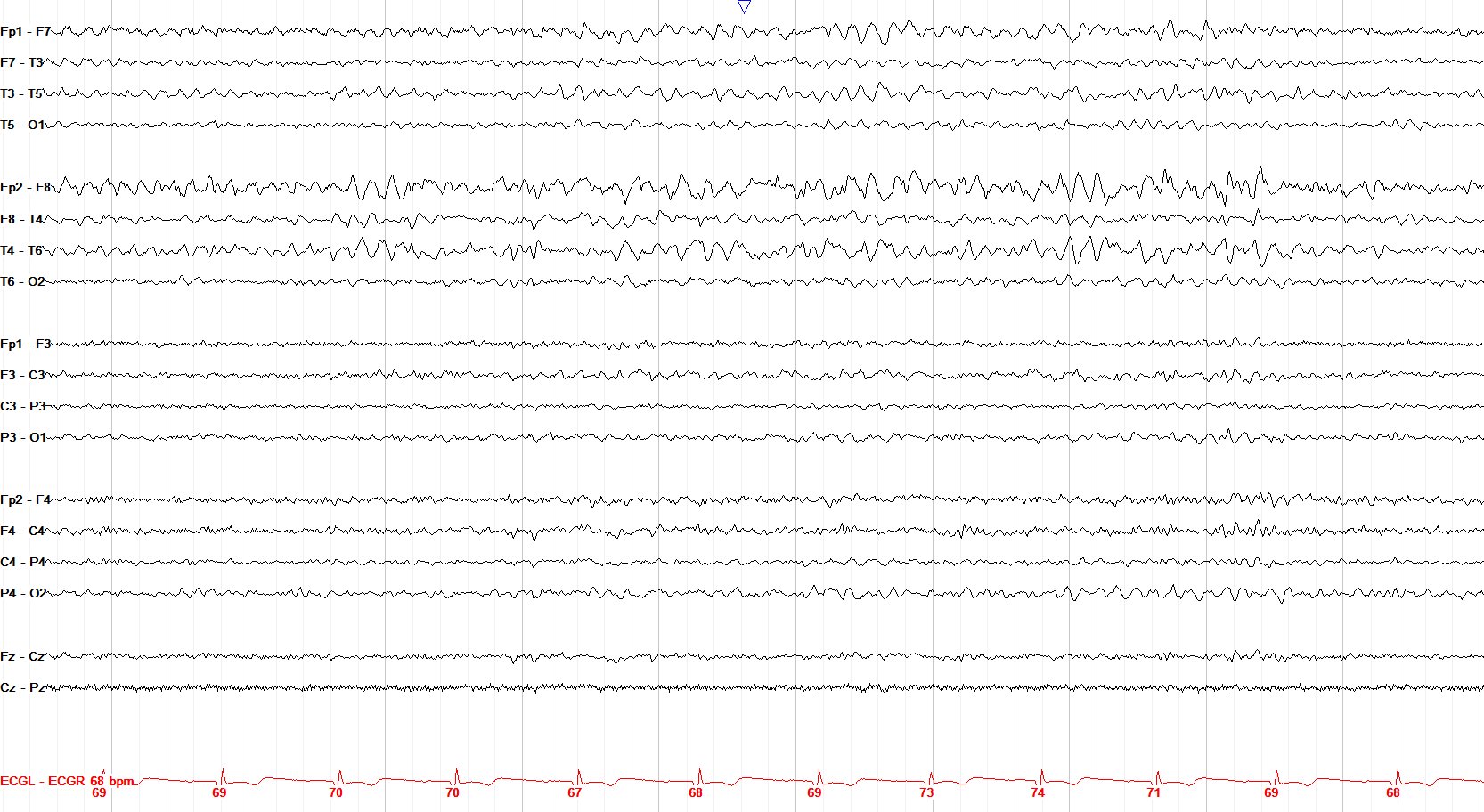 Right temporal breach rhythm