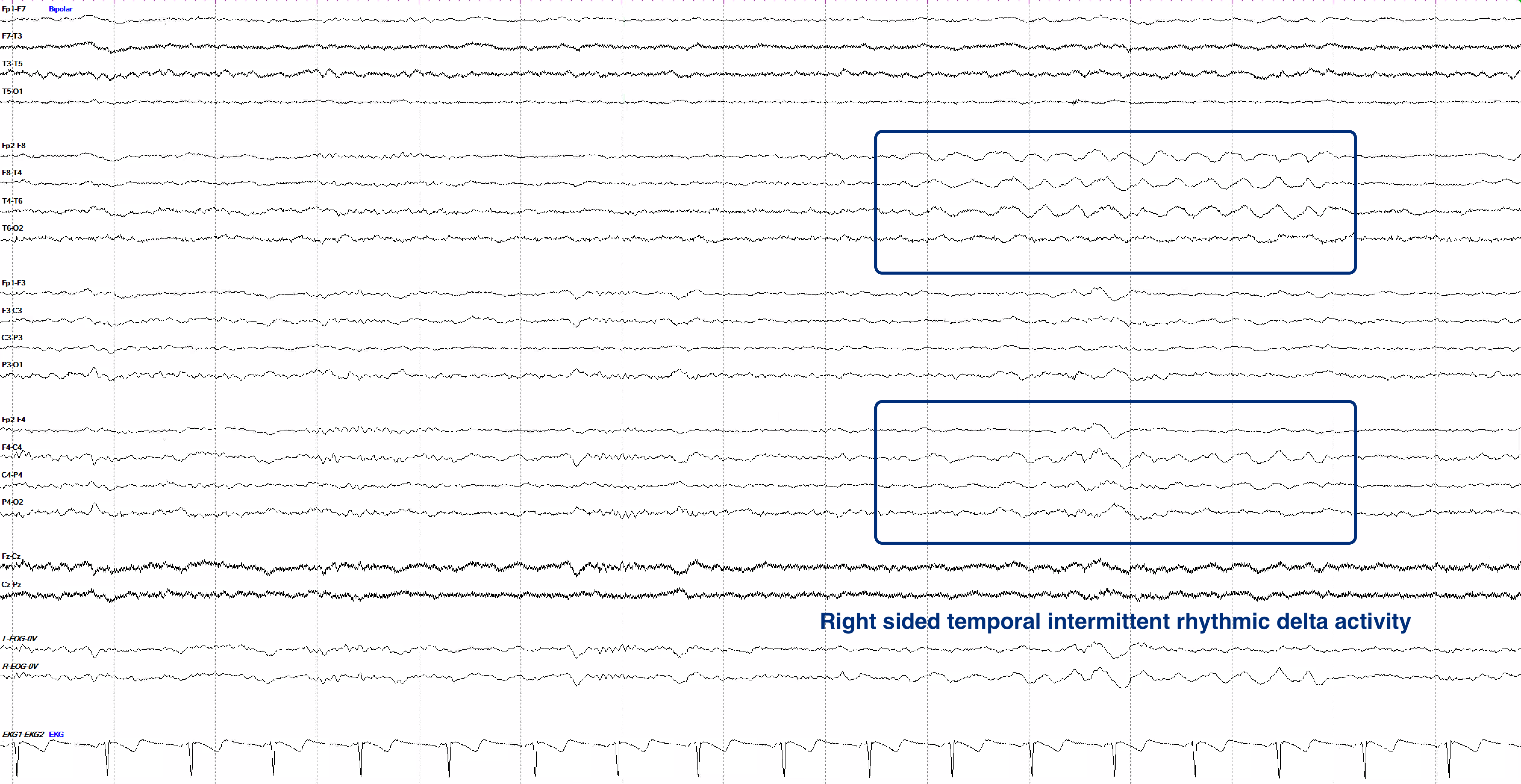 Right-sided temporal intermittent rhythmic delta activity (TIRDA)