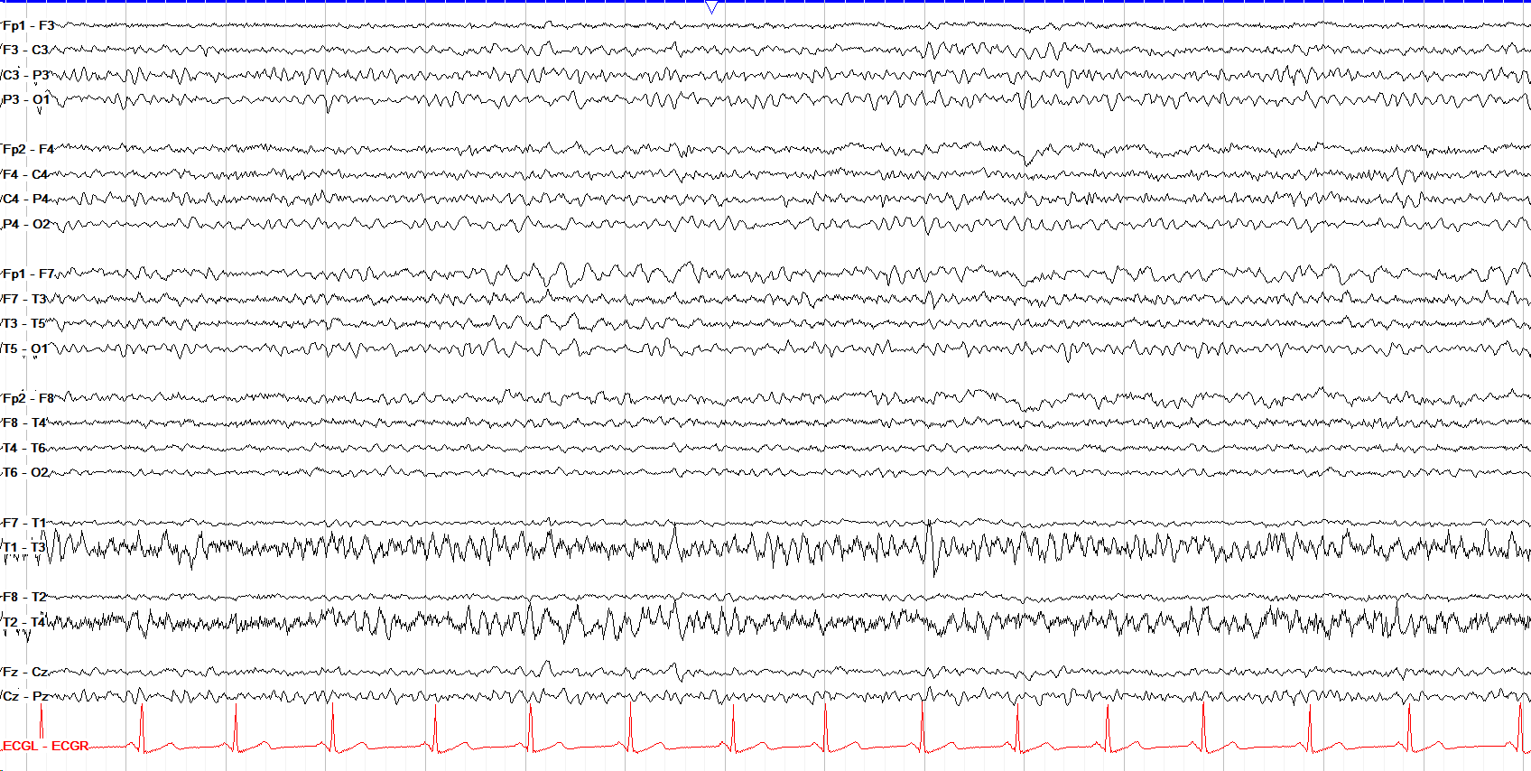 Intermittent on continuous left temporal delta
