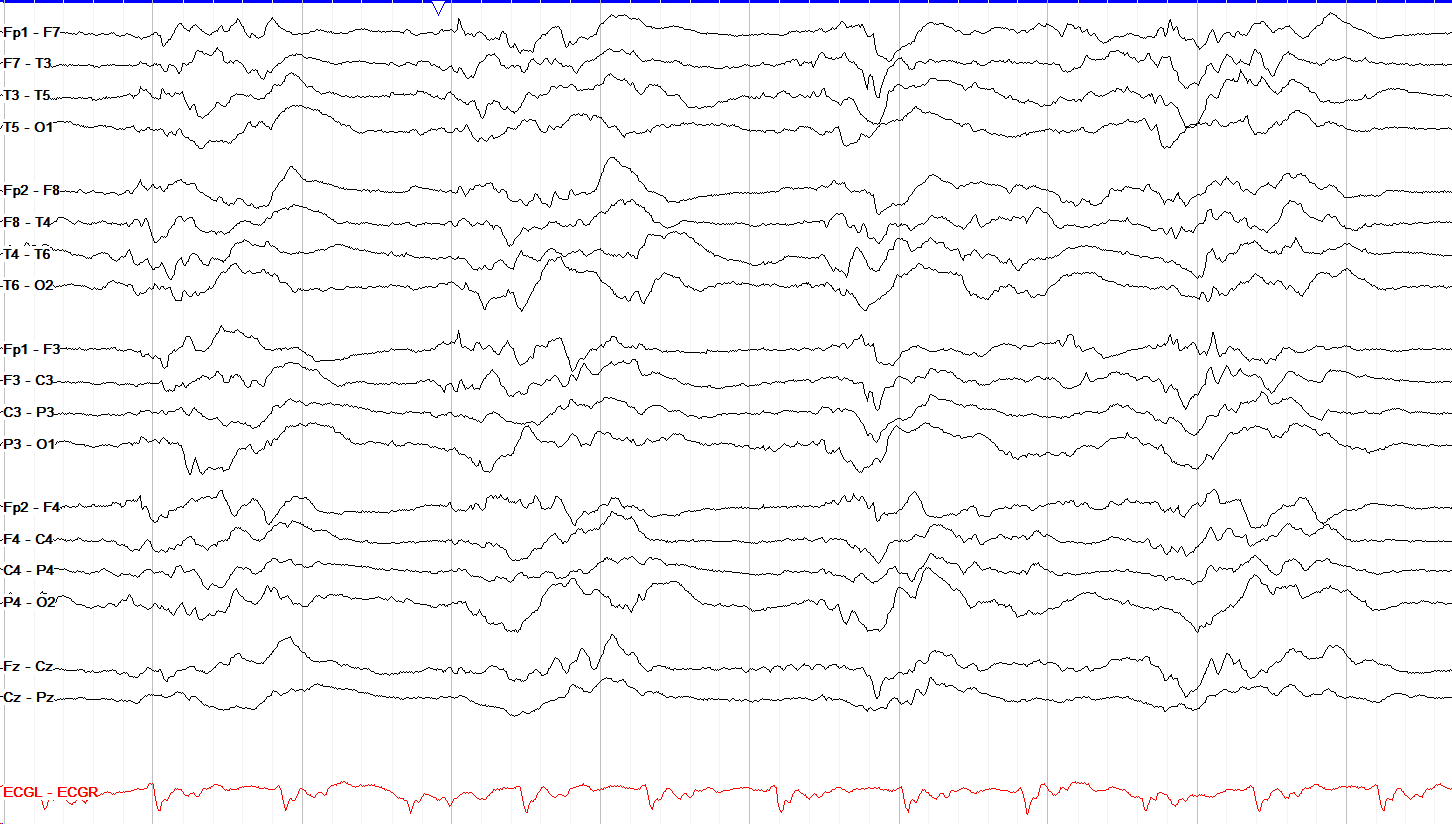 Discontinuity with severe generalized slowing