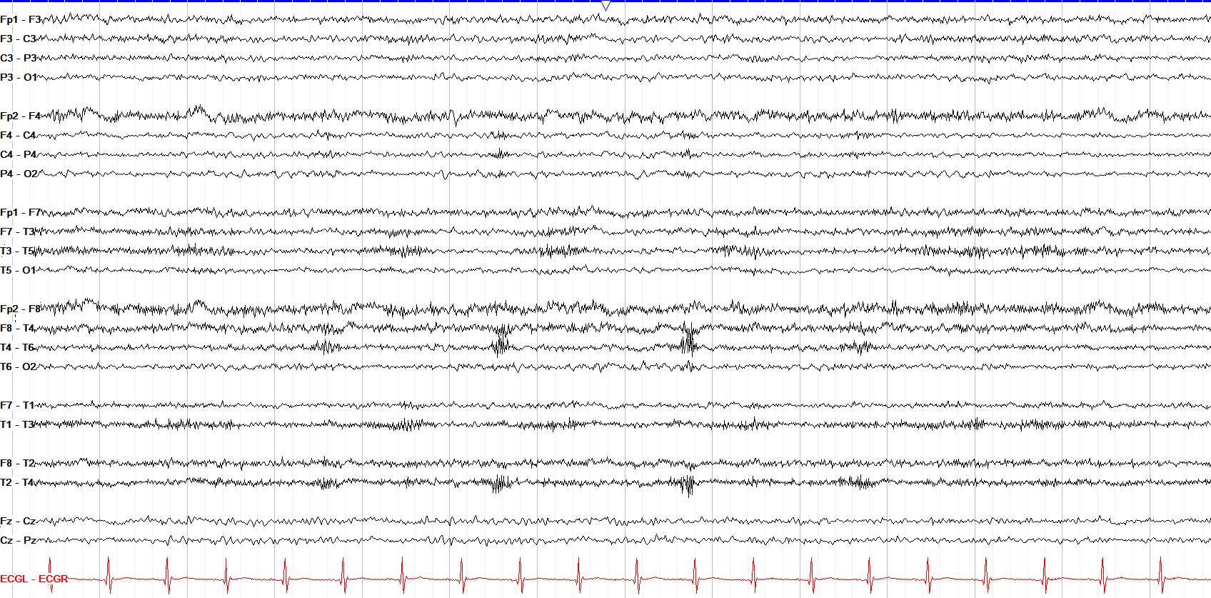 Right anterior quadrant delta slowing
