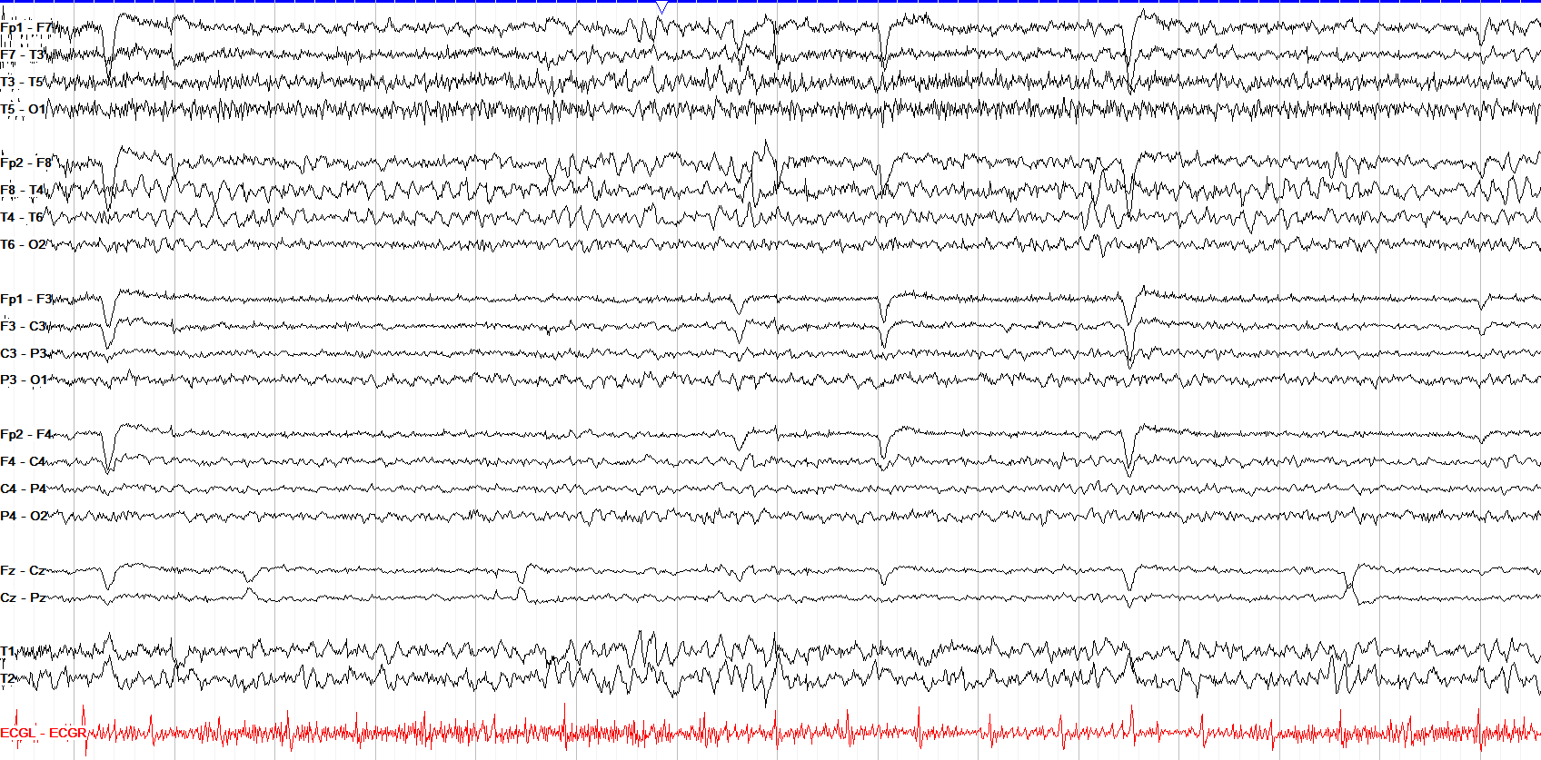 Right temporal slowing and breach