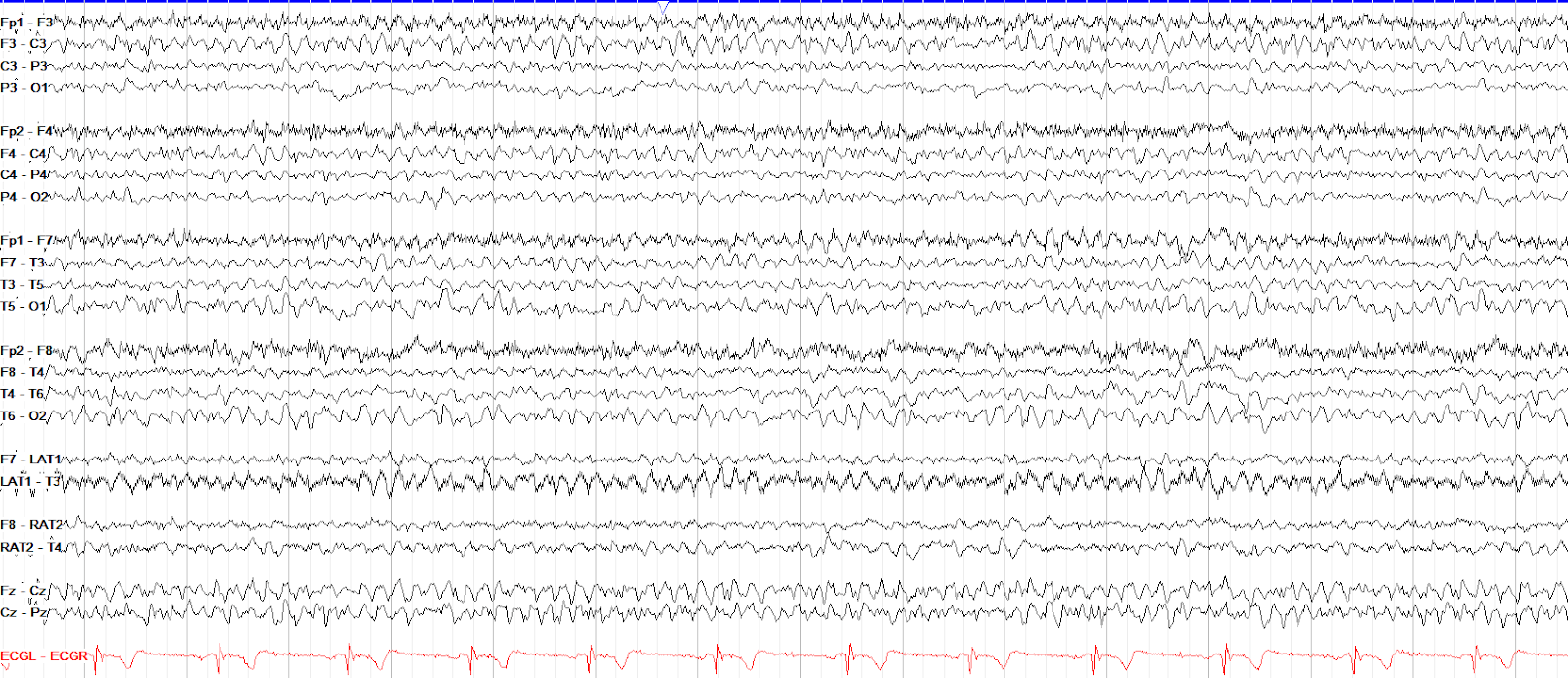 Right temporal polymorphic delta slowing