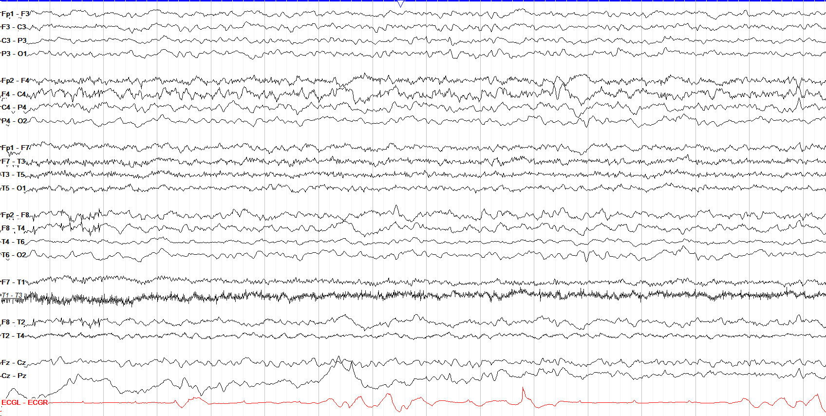 Right hemispheric & left frontal polymorphic delta