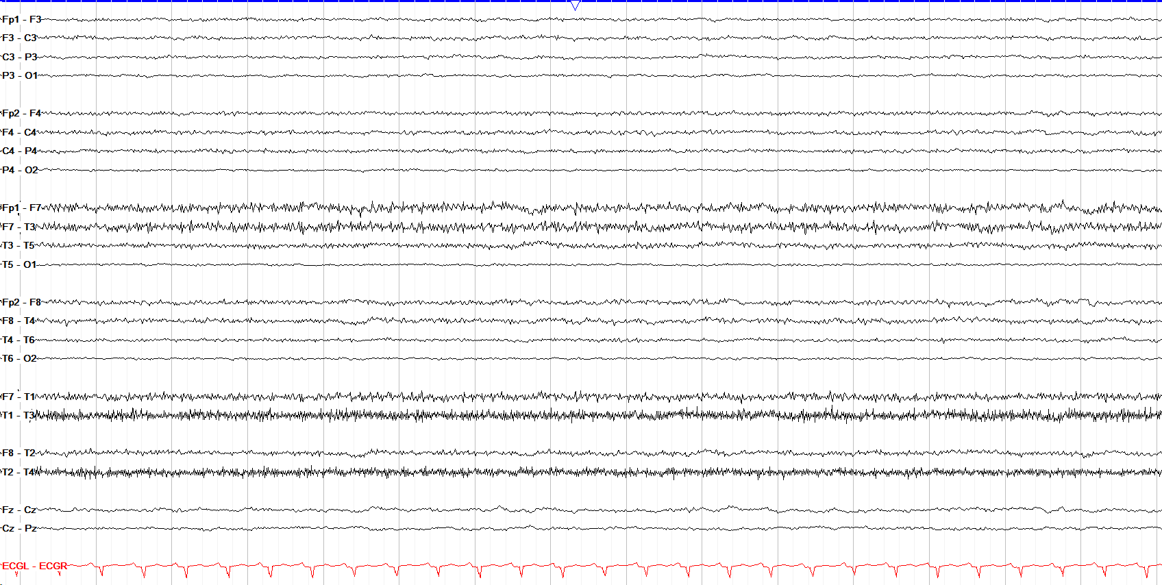 Severe generalized slowing