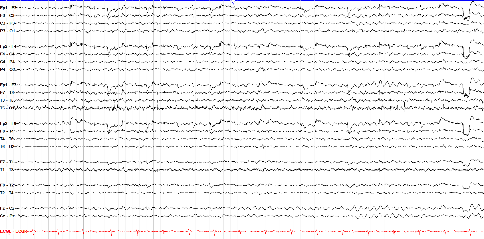 Bifrontal polymorphic slowing