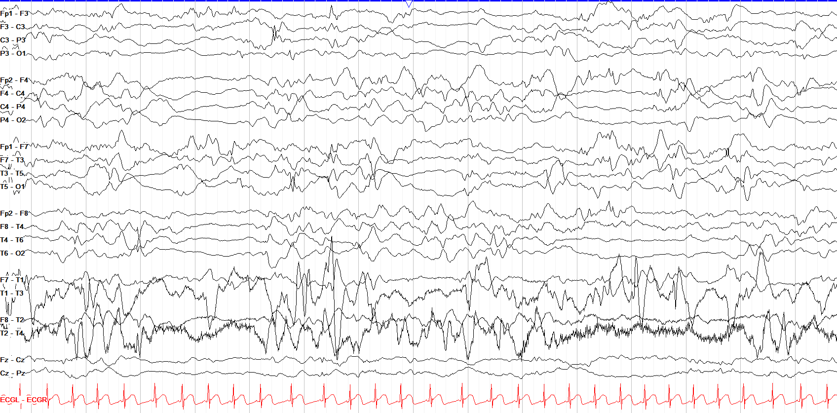 Severe generalized slowing and discontinuity