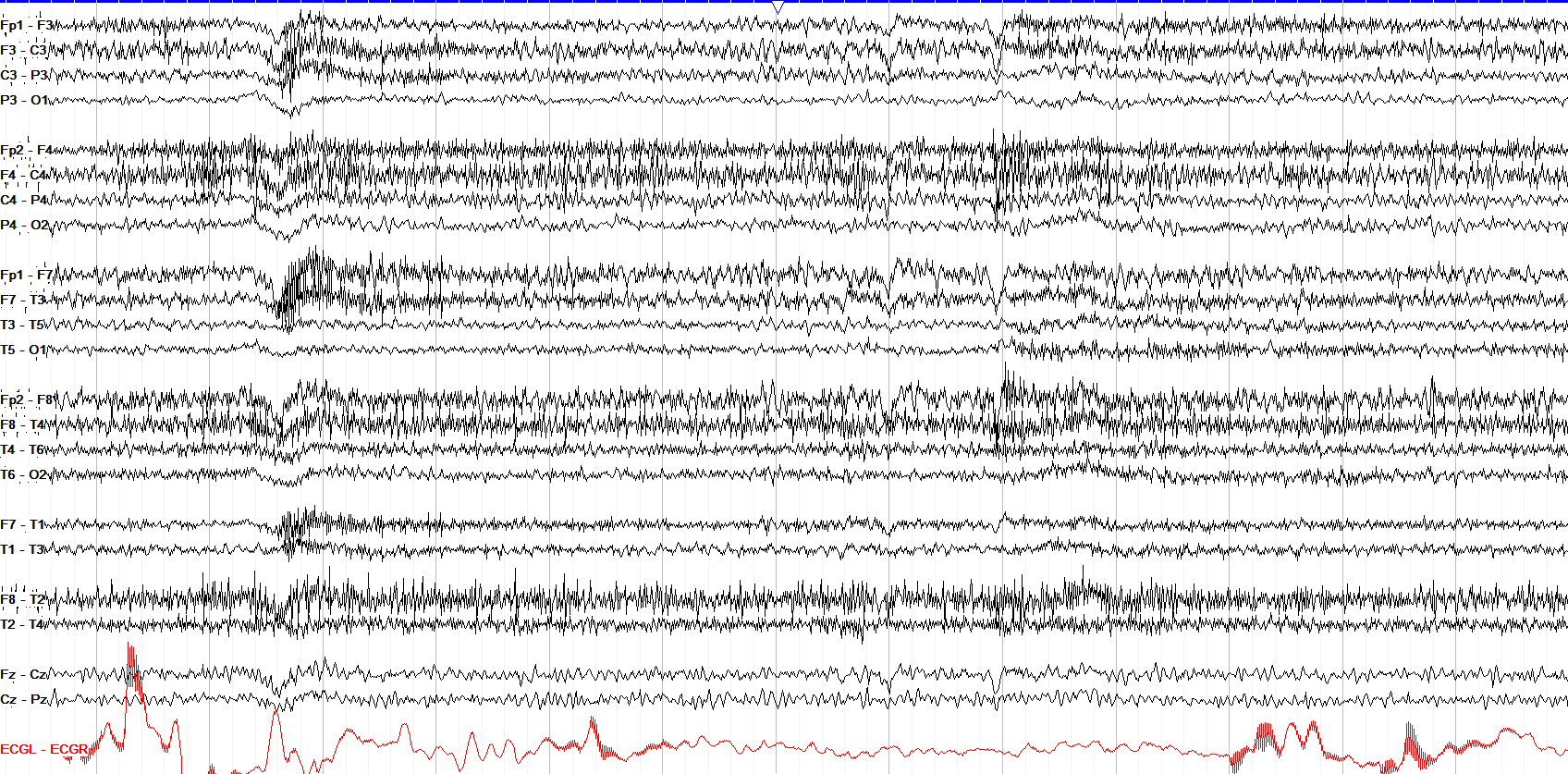 Excess beta with myogenic artifact
