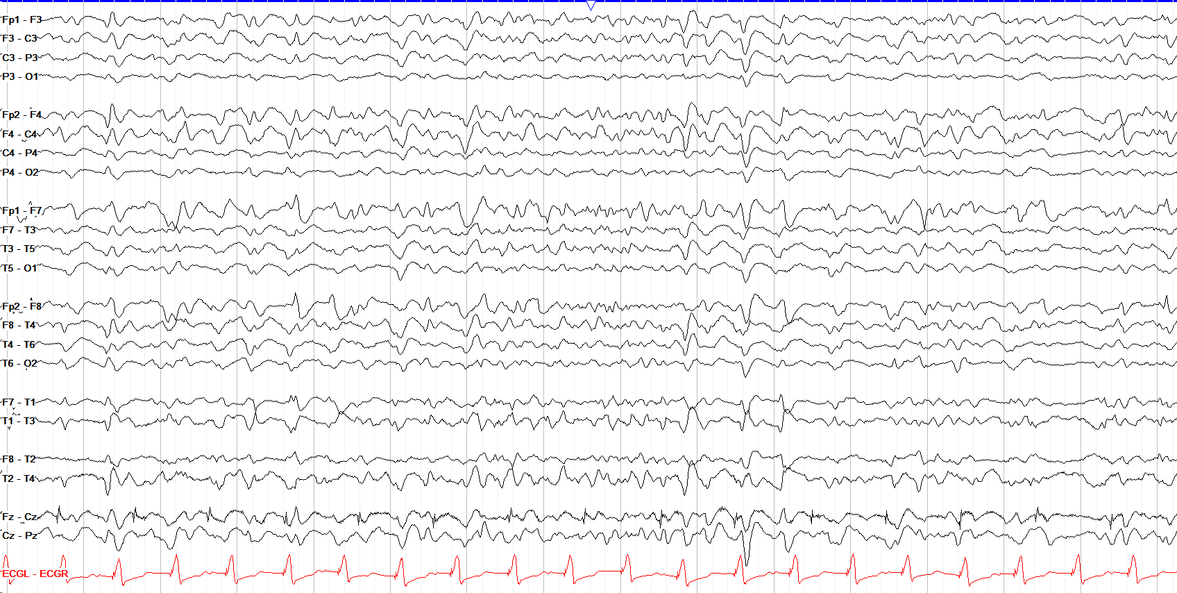 Inconsistent GPDs with triphasic morphology