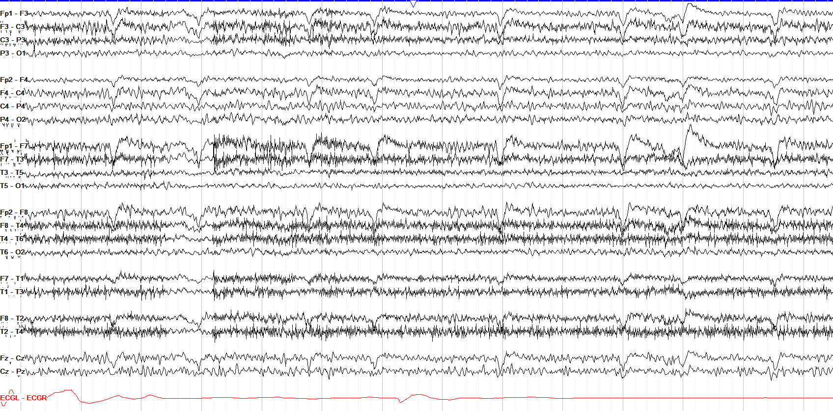 Diffuse excess beta
