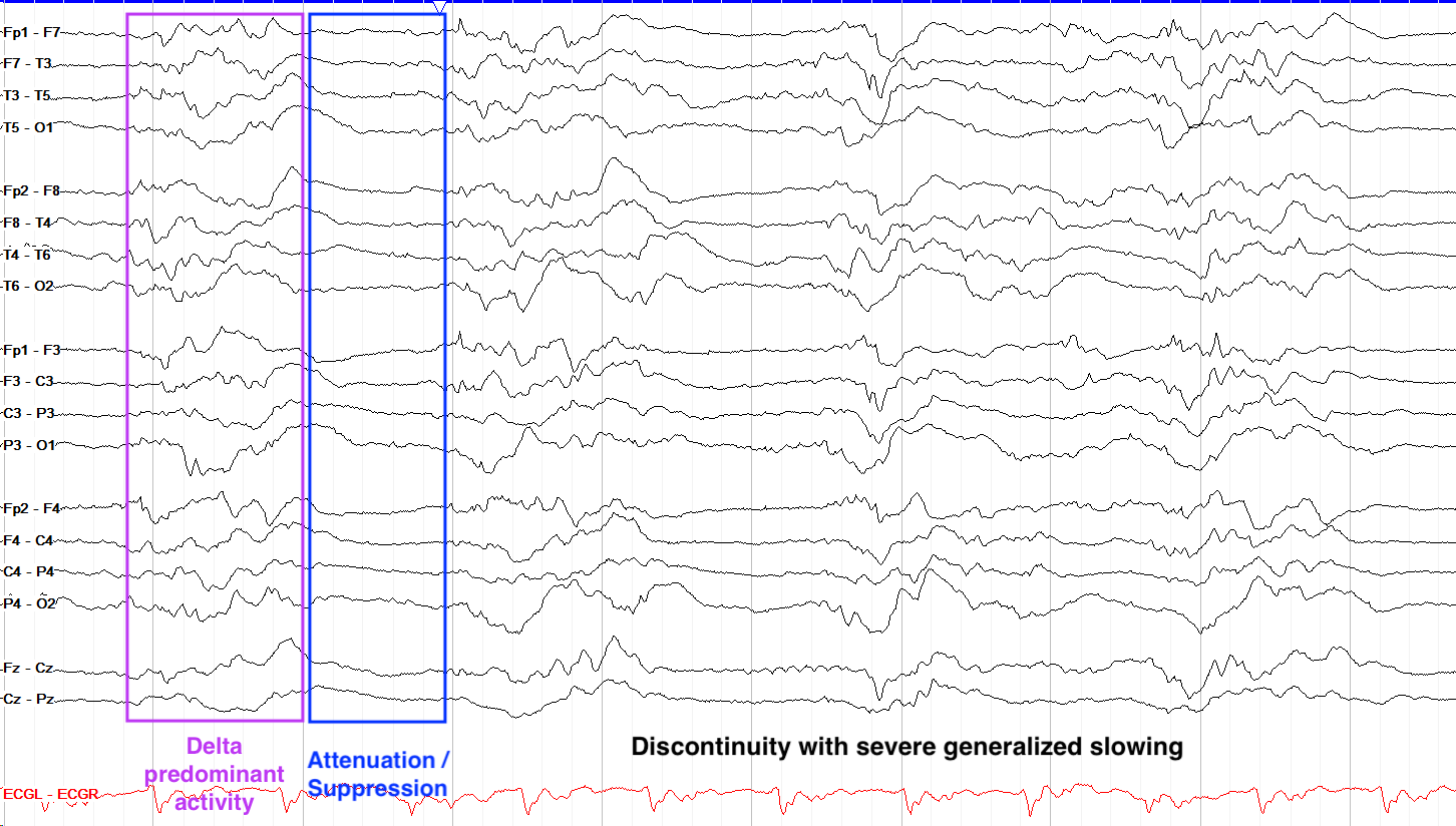 Attenuation and discontinuity example