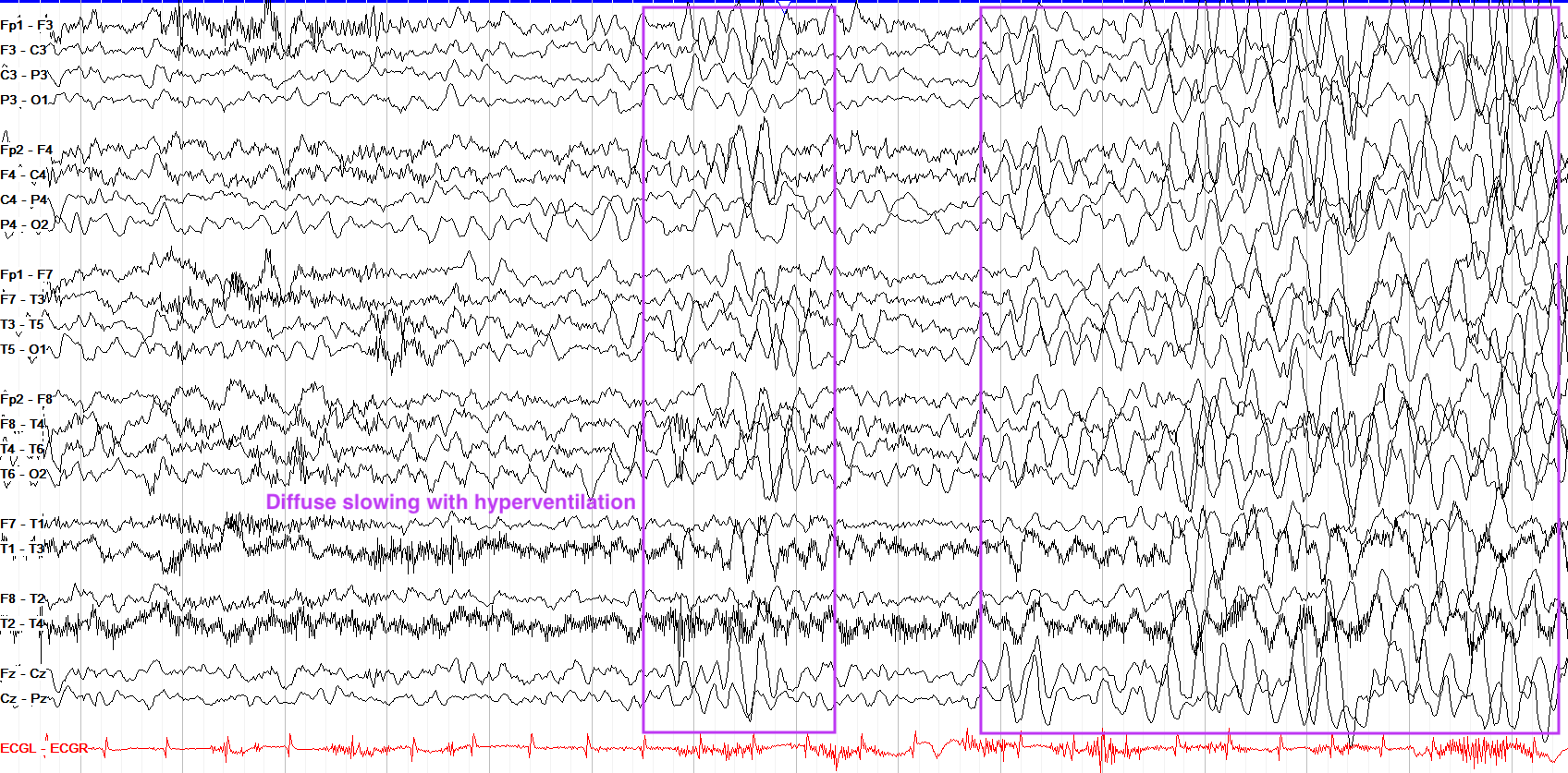 Annotated hyperventilation-induced diffuse slowing