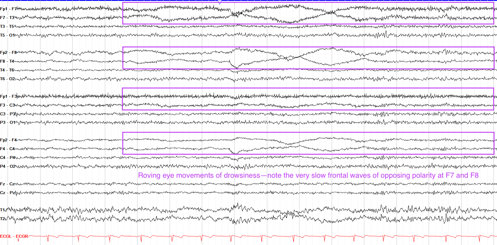 Annotated roving eye movements of drowsiness