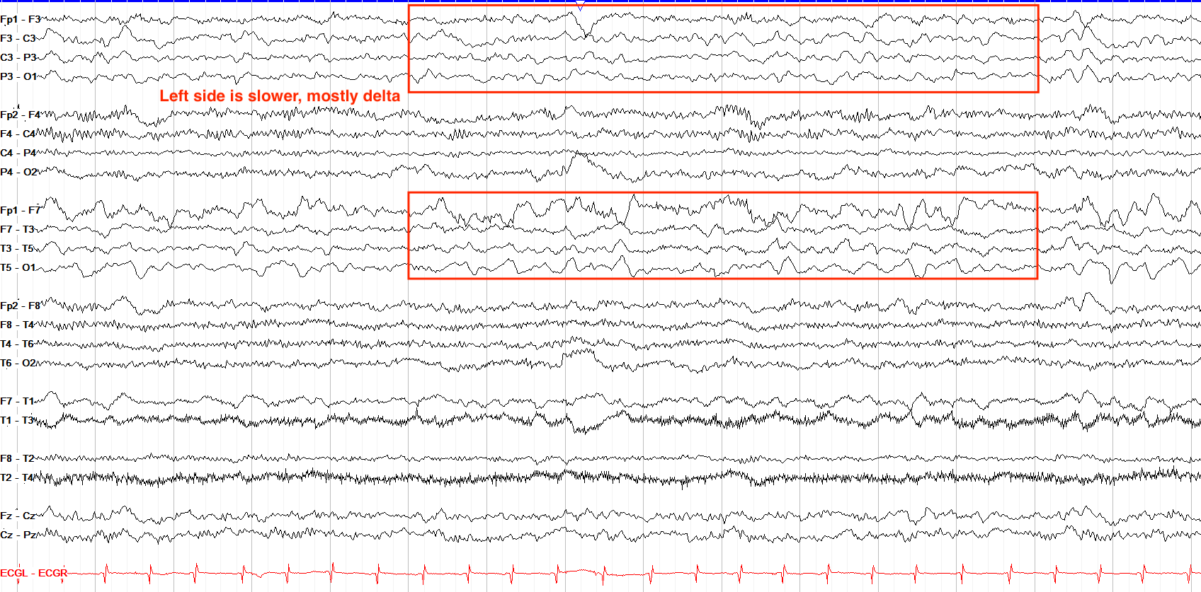 Asymmetric background, higher amplitude and slower on the left
