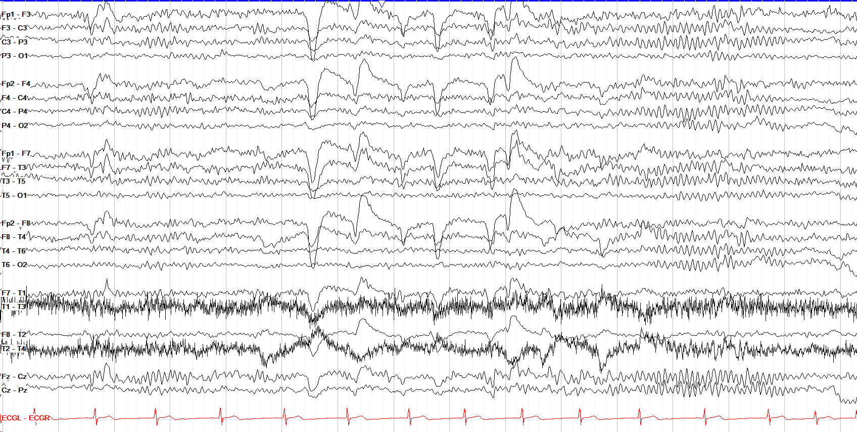 Awake with myogenic artifact