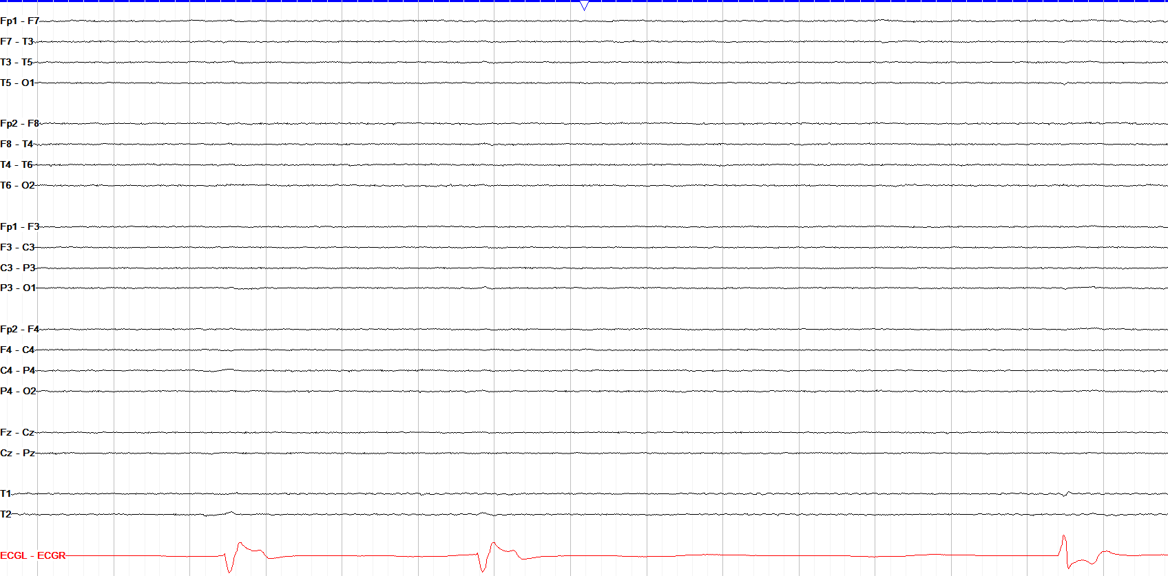 Flat EEG tracing in a brain dead patient
