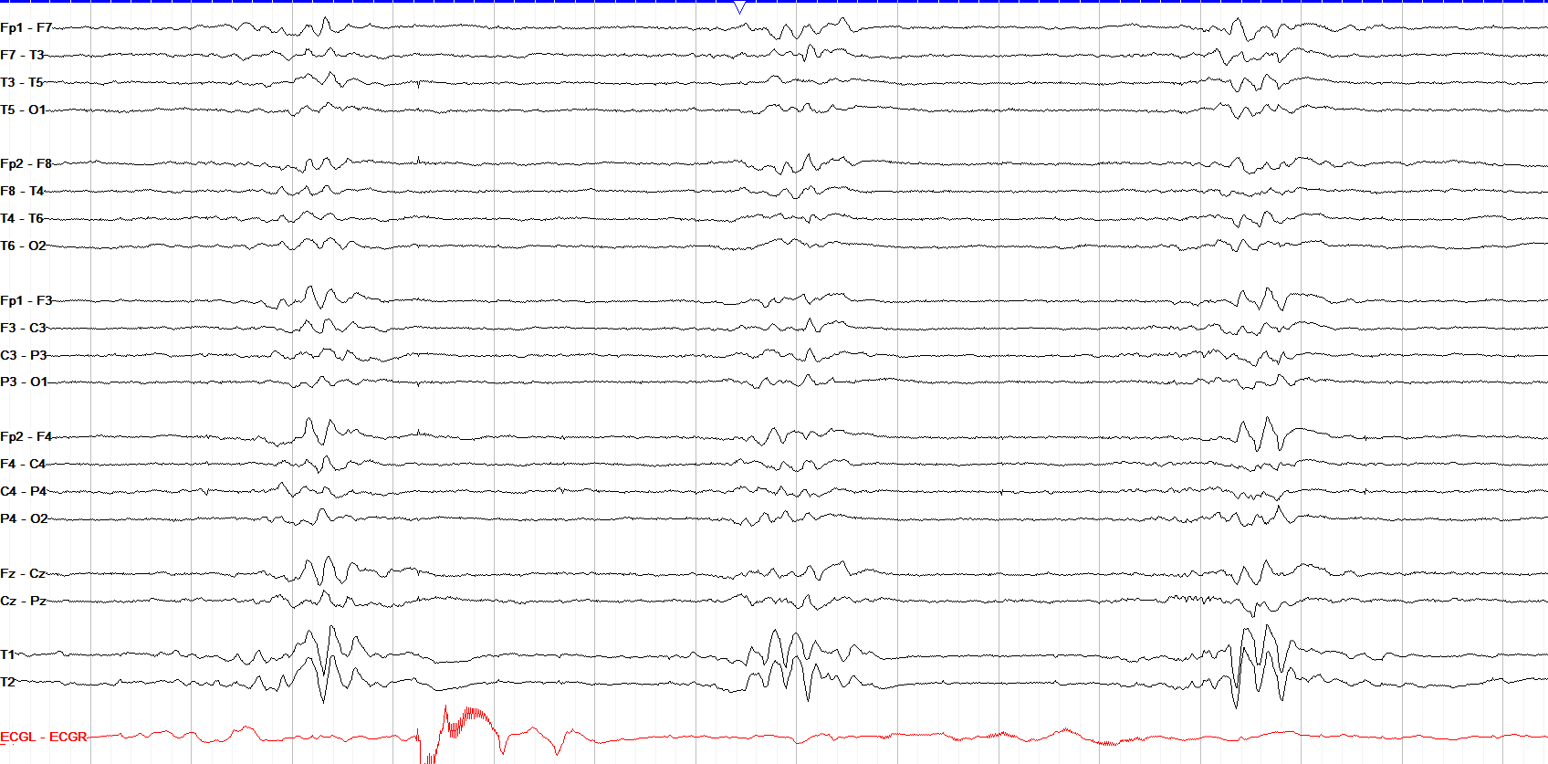 Discontinuous tracing with burst-suppression
