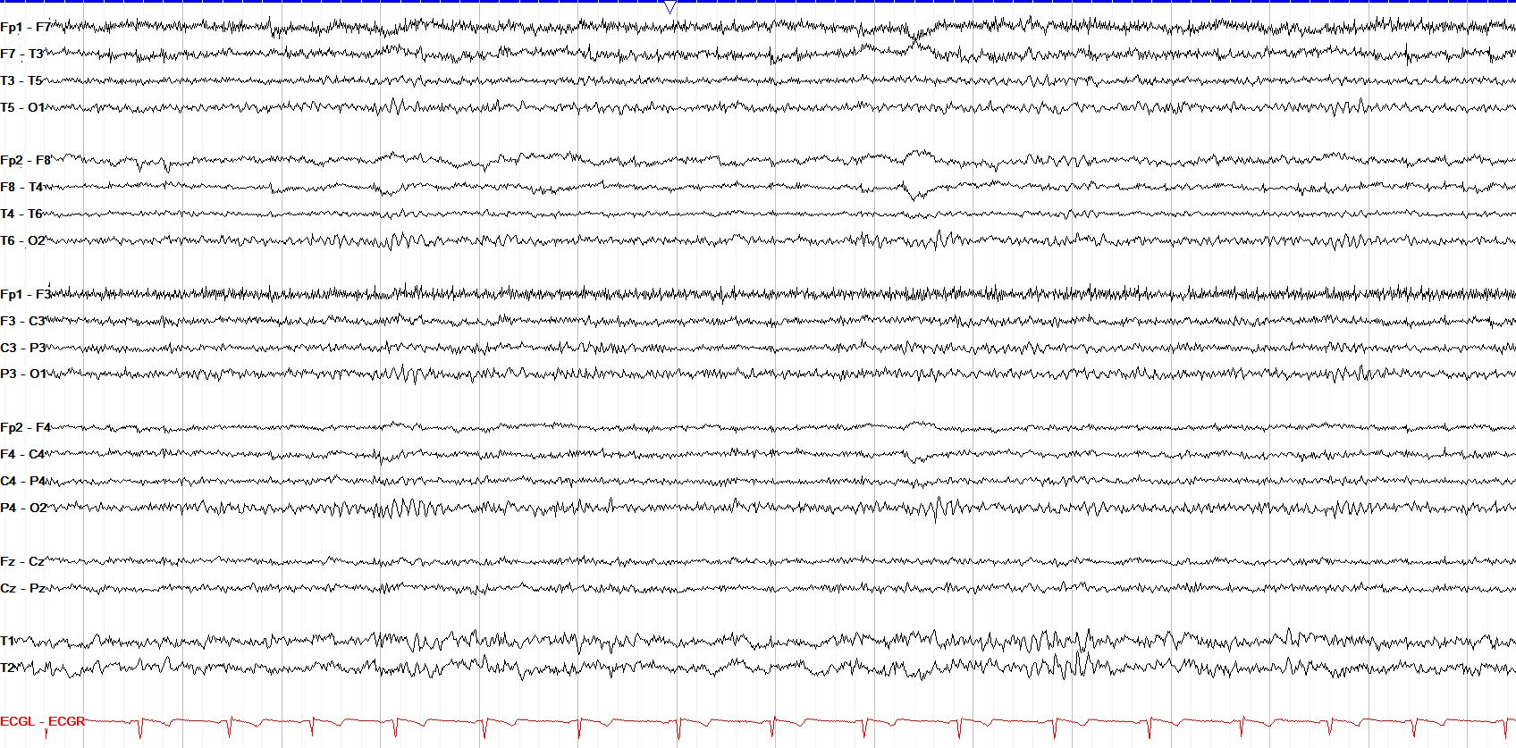 Drowsiness PDR fragmentation