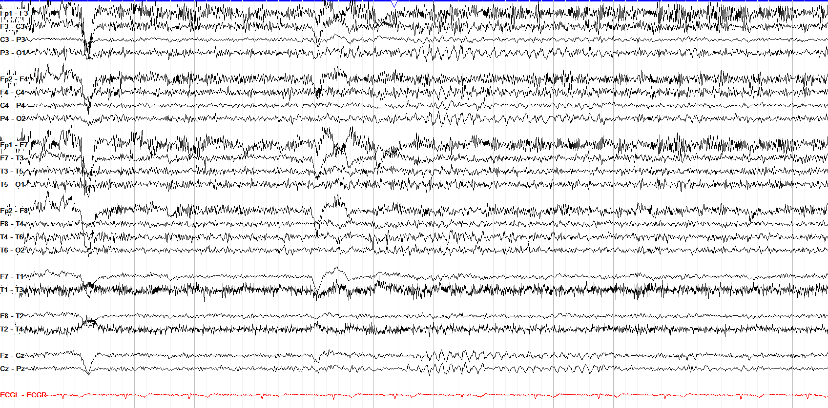 PDR 7-8 Hz