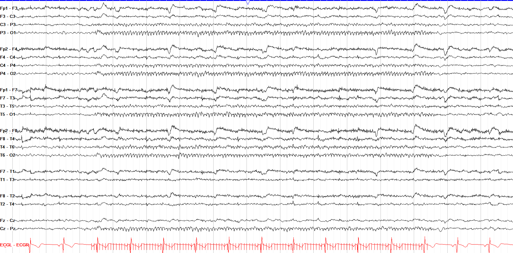 photic driving 12 Hz