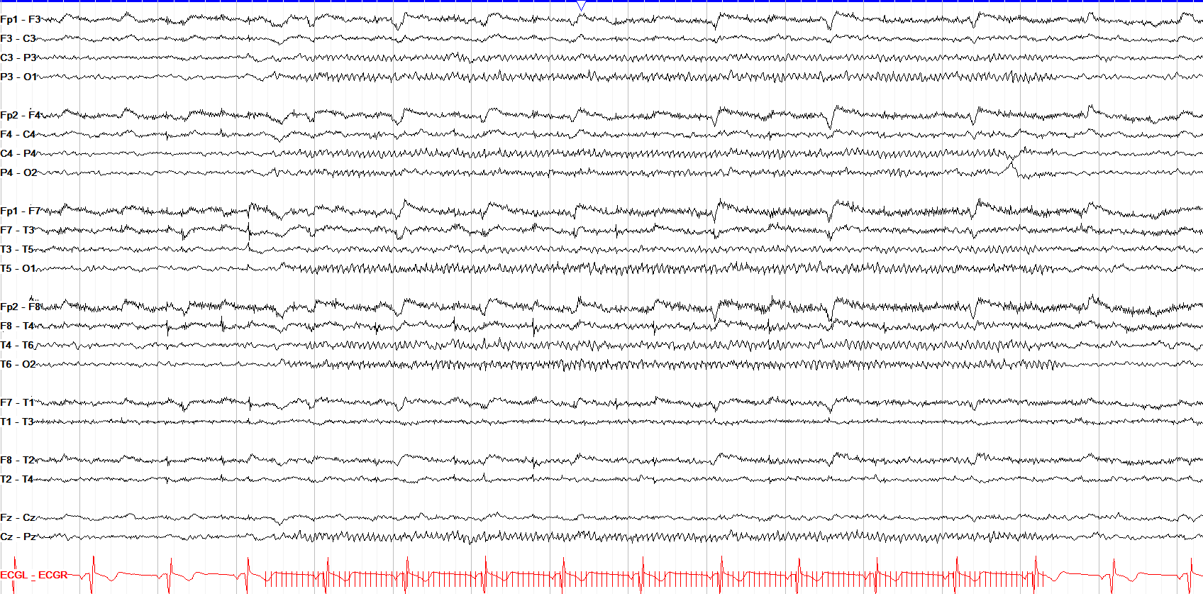 photic driving 15 Hz