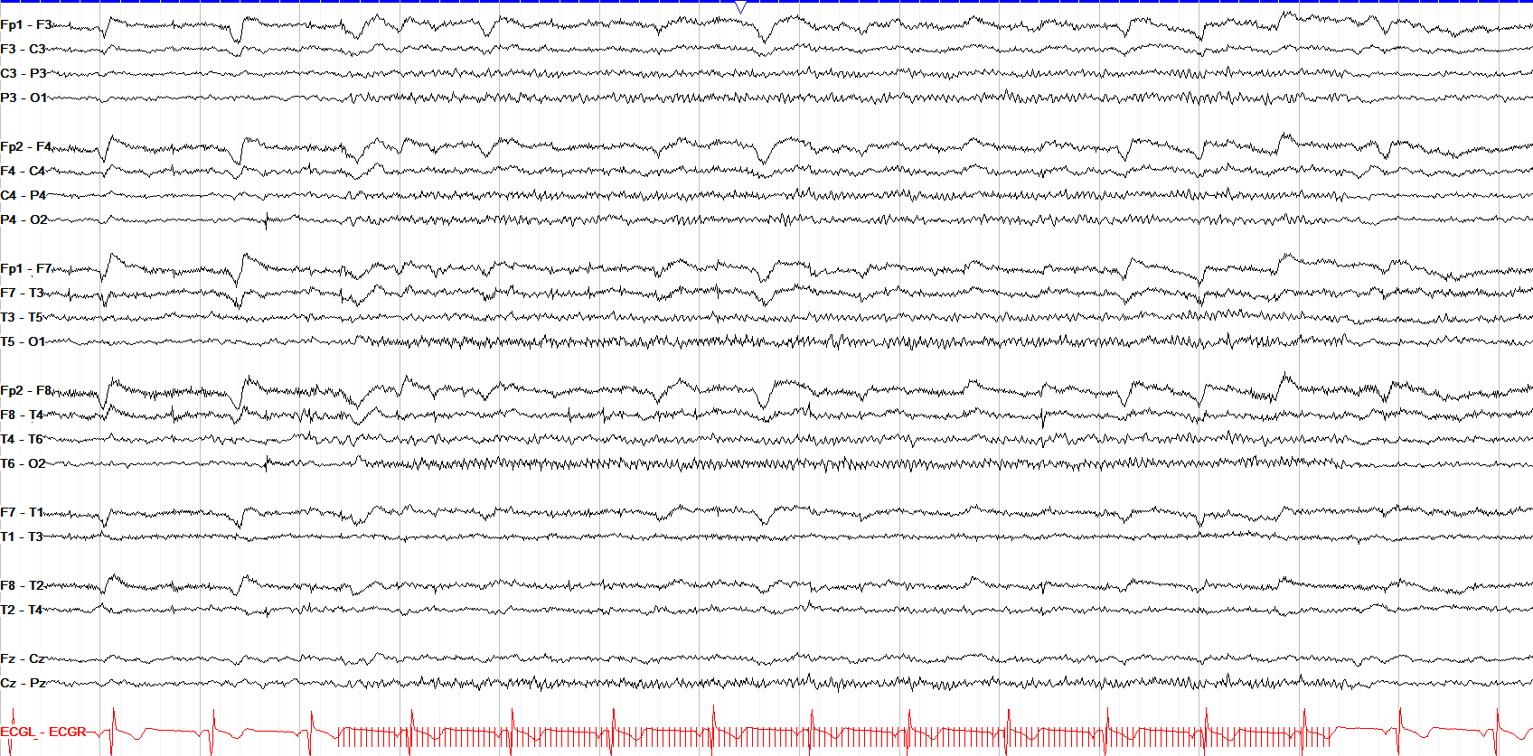 photic driving 18 Hz
