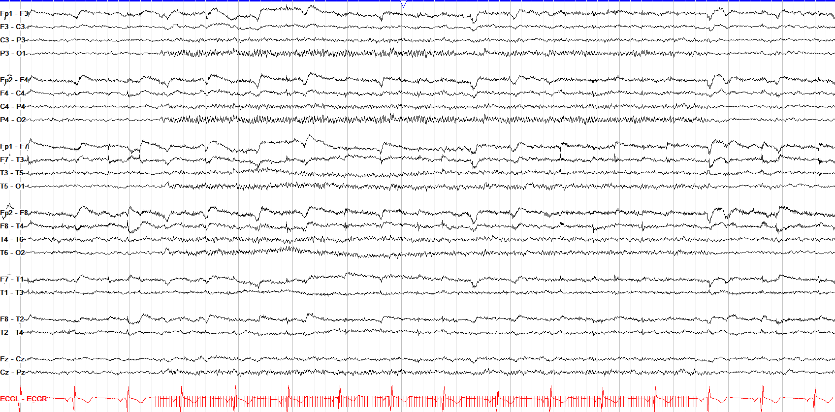 photic driving 21 Hz