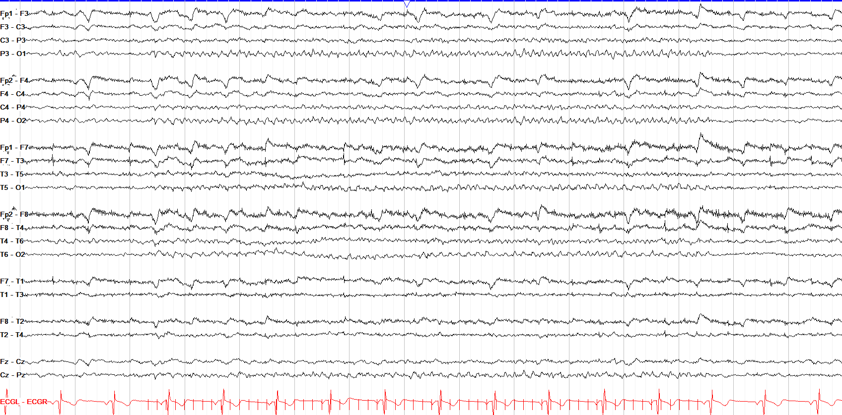photic driving 6 Hz