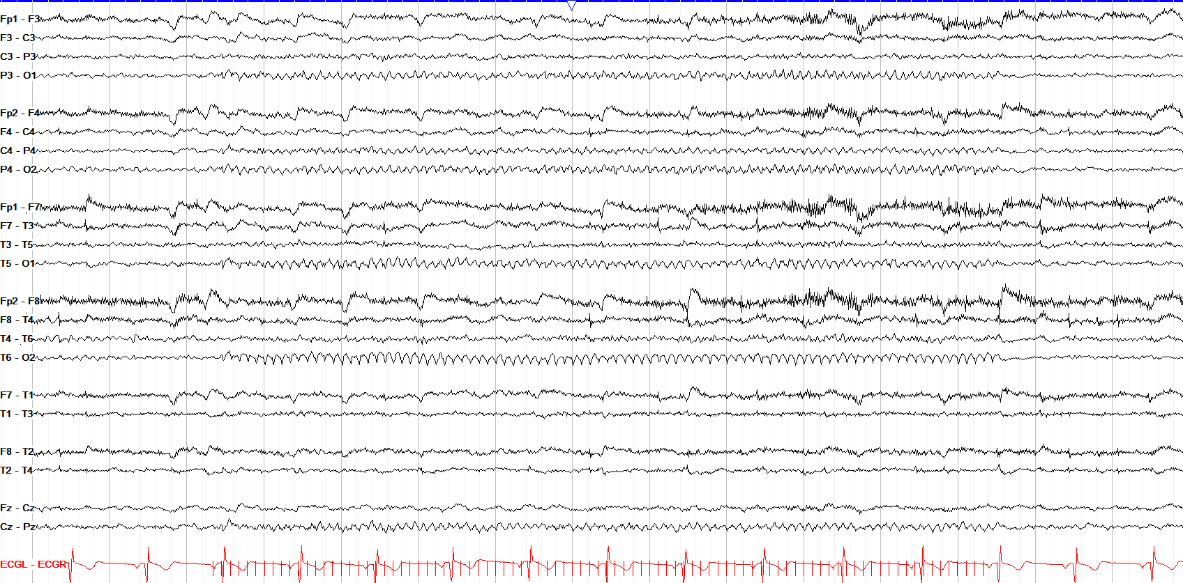 photic driving 9 Hz