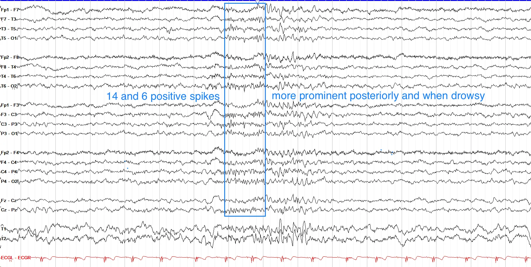 14 Hz positive spikes