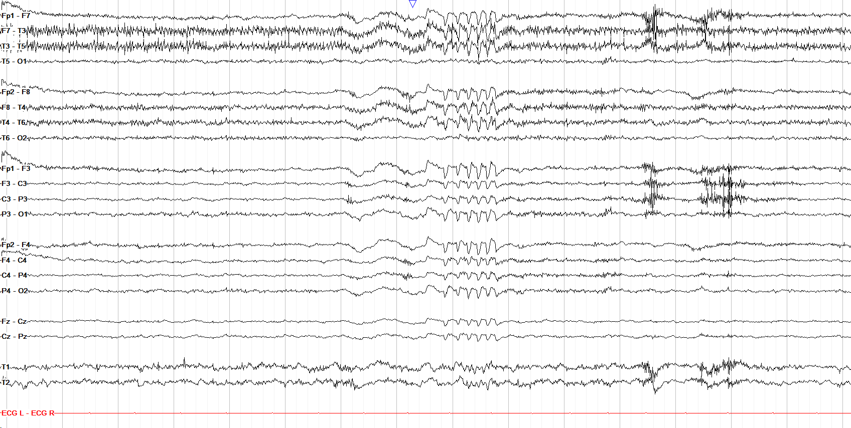 6 Hz Positive Spikes
