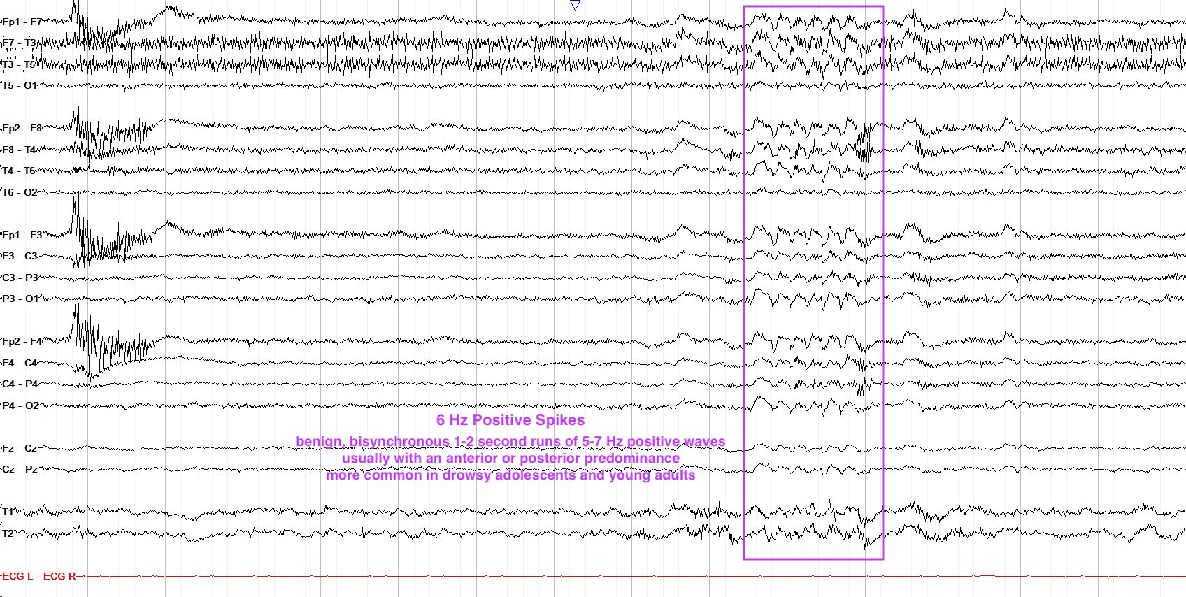 6 Hz positive spikes
