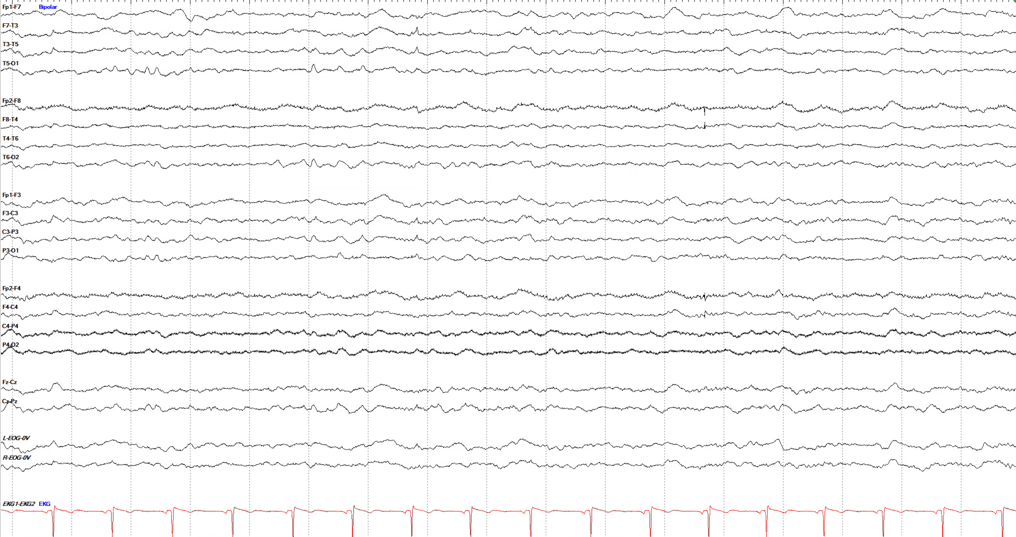 Left temporal BET