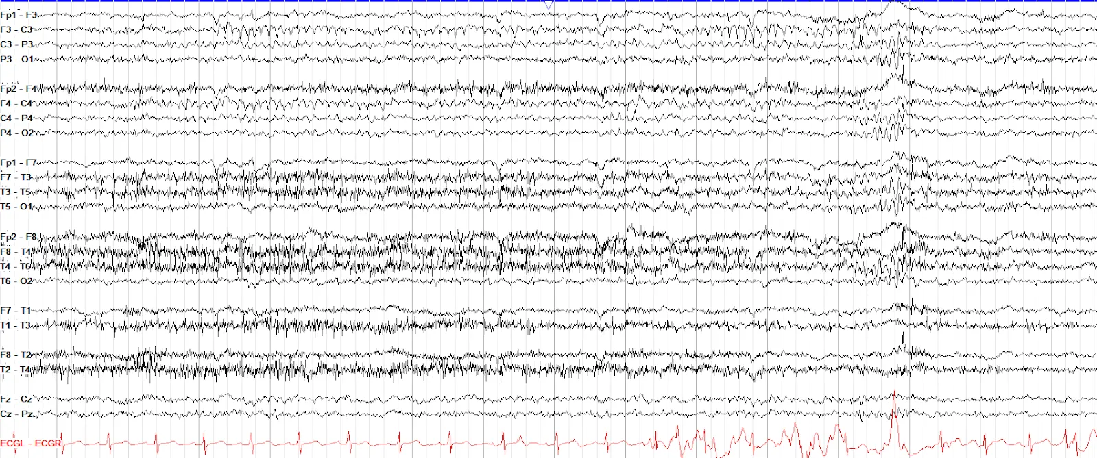 Mu rhythm