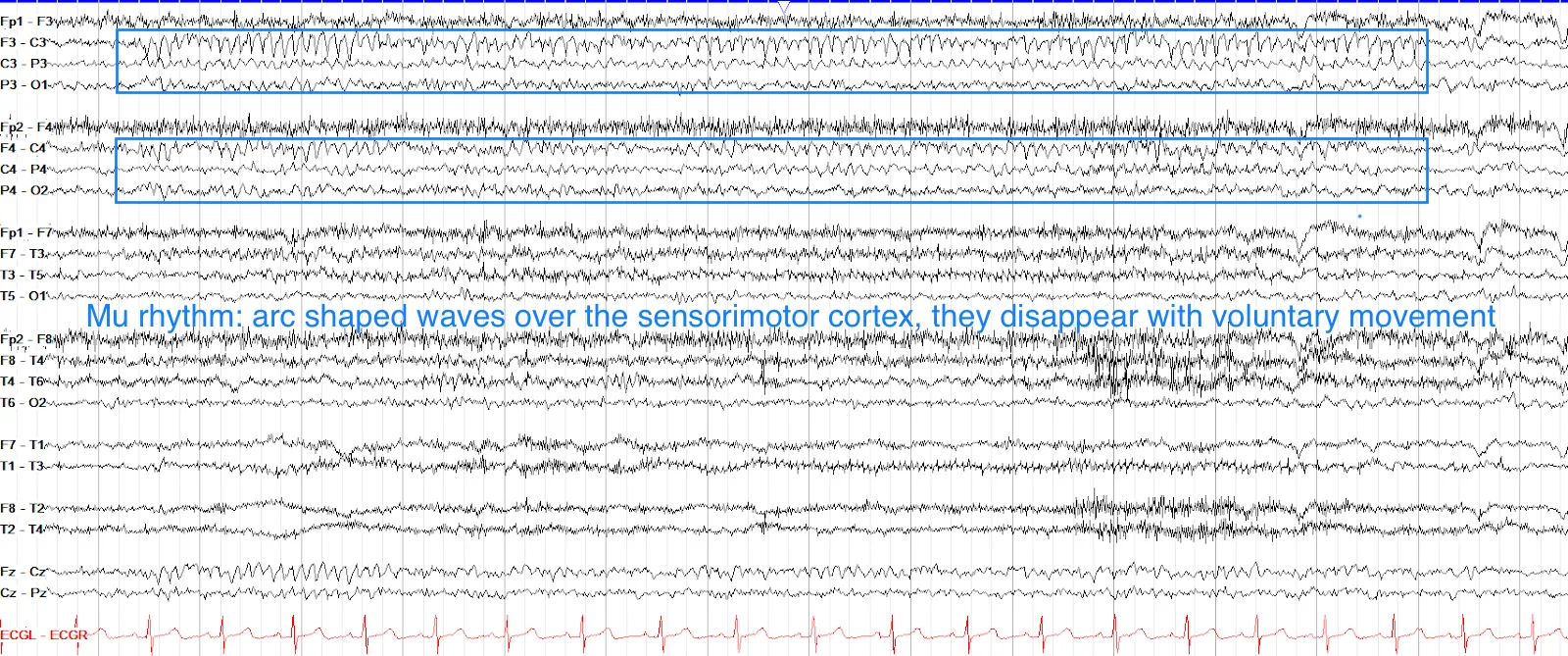 Mu rhythm over parasagittal regions