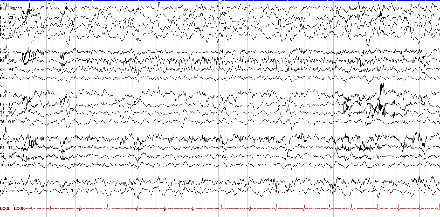 Mu rhythm with left hemispheric slowing