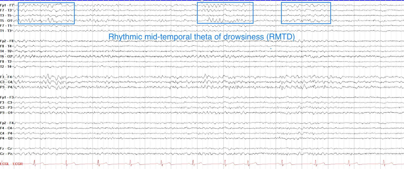 RMTD pattern